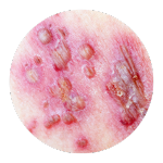 Imagem de um ícone representando a sessão Herpes Zoster