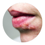 Imagem de um ícone representando a sessão Herpes simples